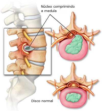 herniadisco